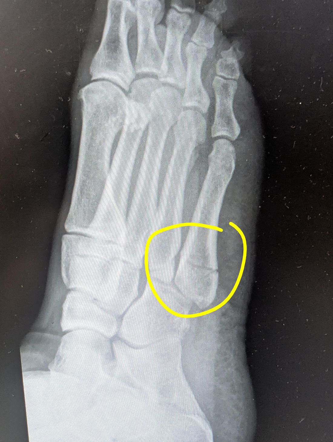An X-ray of a foot with a metatarsal fracture circled in yellow marker